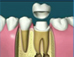 root canal